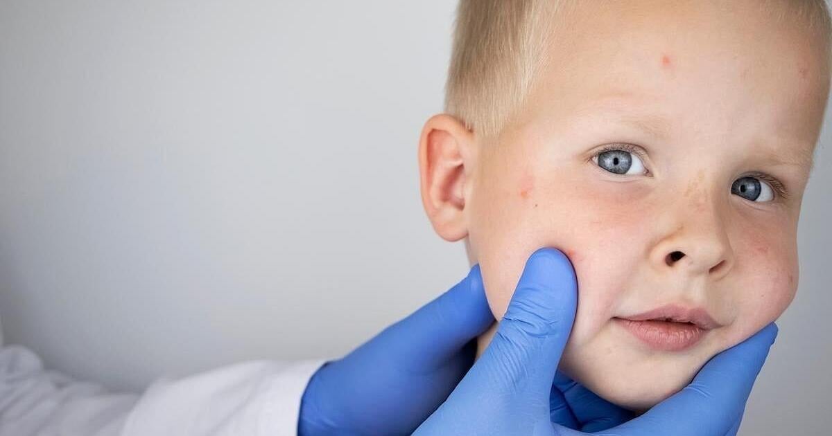 Child in Los Angeles Dies of Rare Brain Disorder Caused by Measles | Health