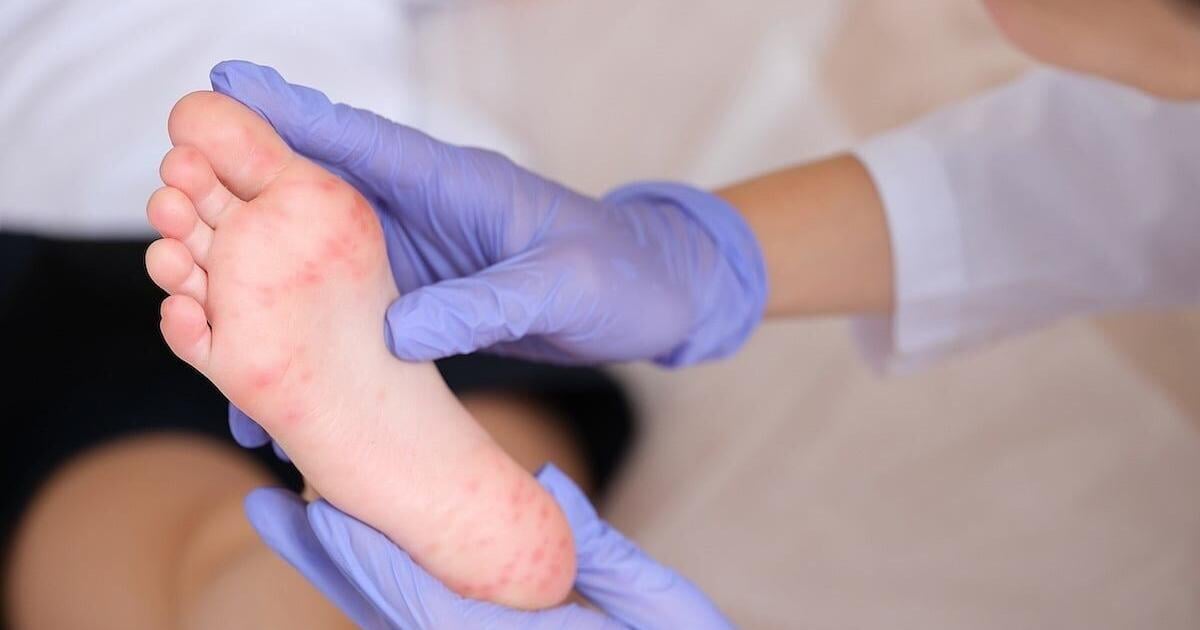 Minnesota Confirms 10 New Measles Cases, All in Unvaccinated Travelers | Health