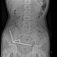 Surgeons remove up to 100 magnets from N. Zealand teen’s gut | National