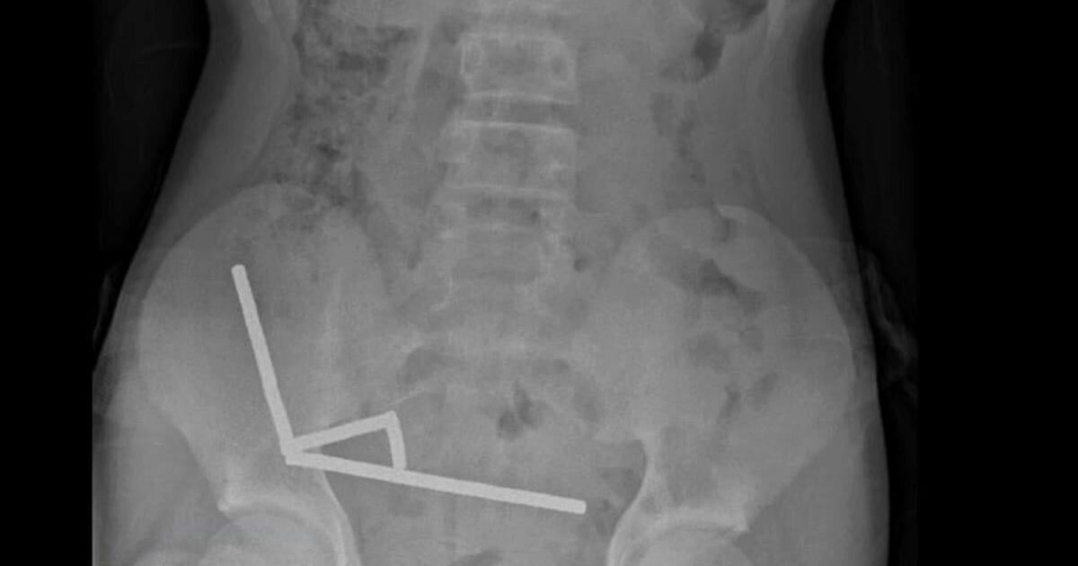 Teen Loses Part of Bowel After Swallowing 80+ Magnets | Health